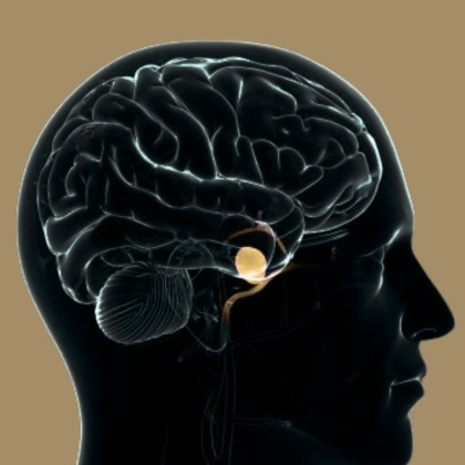 Aneurysm Coiling illustration
