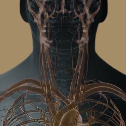 Mechanical Thrombectomy illustration