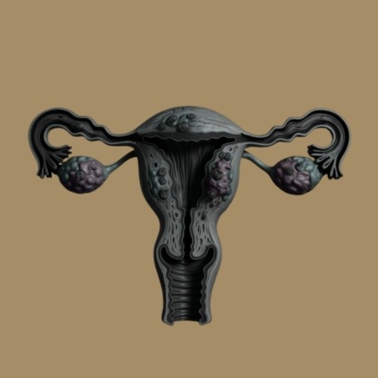 Uterine Fibroid Embolization illustration